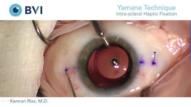 Scleral Fixation for Delayed Bag-IOL Dislocation | Ento Key