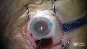 Surgery for a Dense Cataract