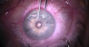 Epithelial Ingrowth 16 Years After LASIK Enhancement