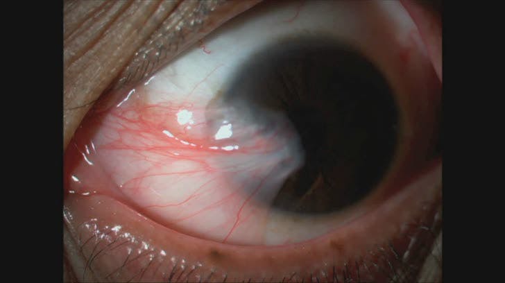 New Technique of Bulbar Flap Conjunctival Pedicle - Eyetube