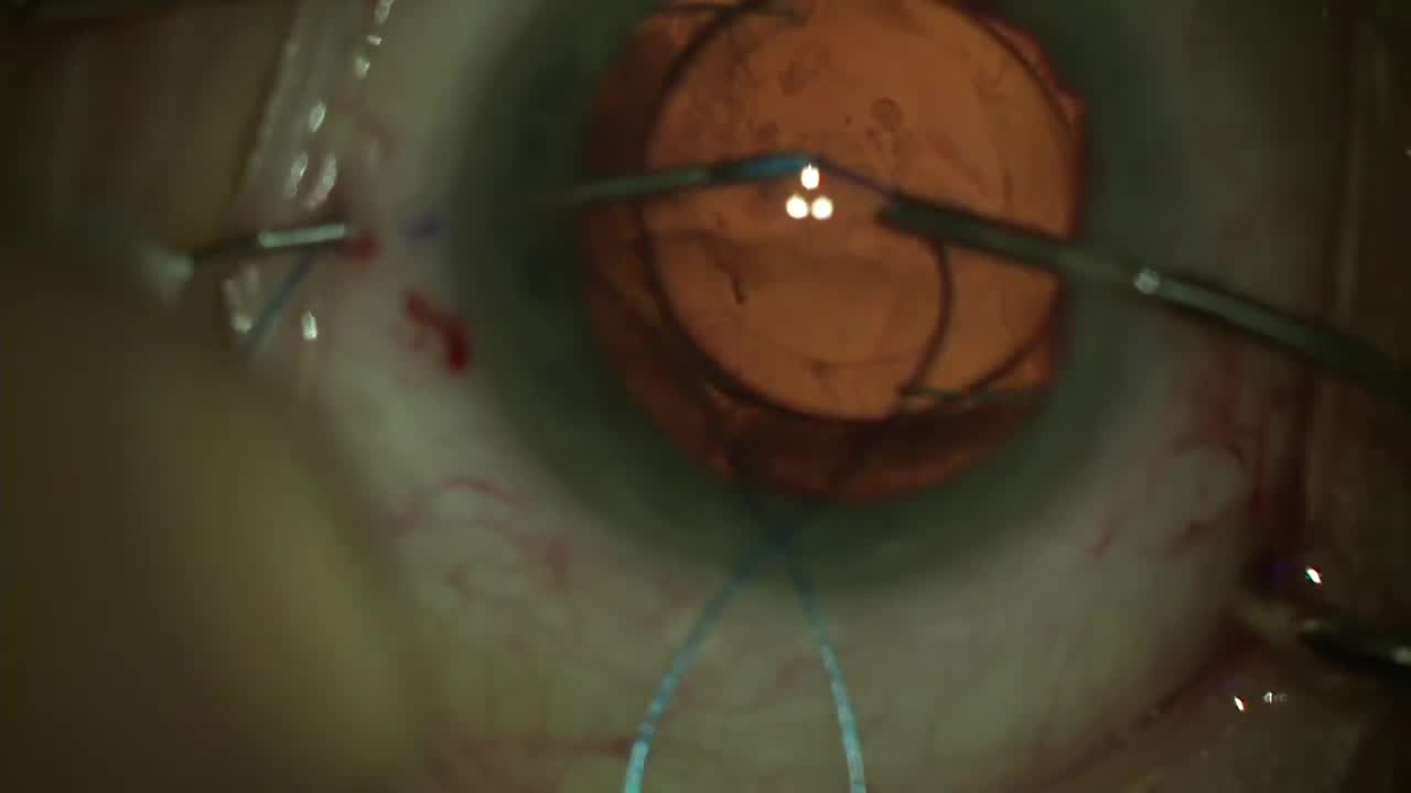 Glued intrascleral haptic fixation of an intraocular lens Narang P, Agarwal  A - Indian J Ophthalmol