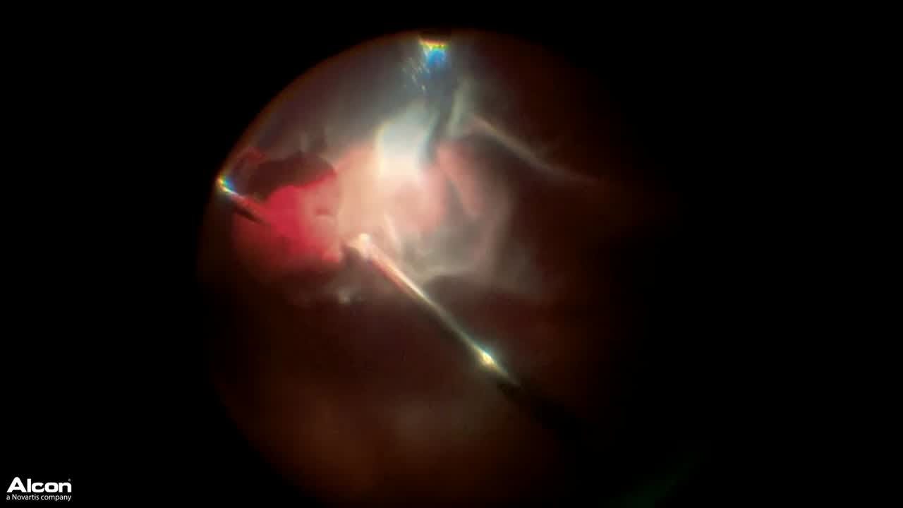 Scleral Buckling - Eyetube