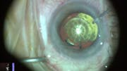 Toric IOL Placement With LENSAR IntelliAxis