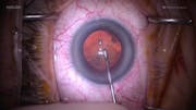 Cataract Surgery With Pseudoexfoliation and Phacodonesis