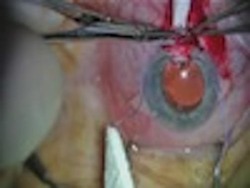 Cataract Surgery Combined with Canaloplasty
