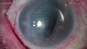 Inside the Wills Eye OR: Complications With an ACIOL