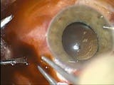 Choroidal Hemorrhage After 23-Gauge Vitrectomy - Eyetube