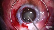 Cataract and a Dense Corneal Scar
