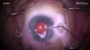 Cataract Surgery in the Setting of Pseudoexfoliation