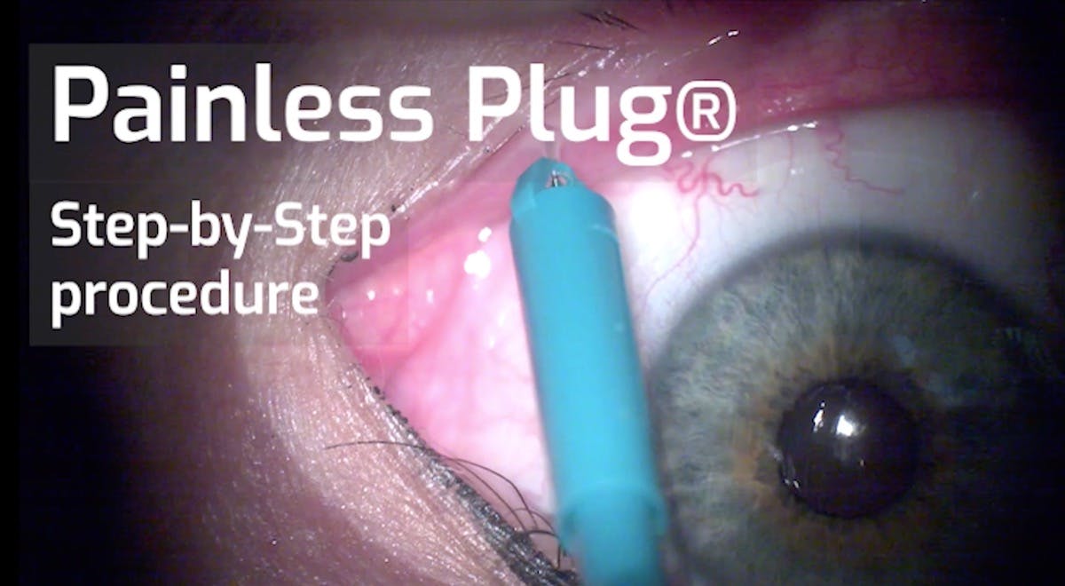 Painless Plug® | International | Permanent Punctum Plug | Step-by-step  Procedure