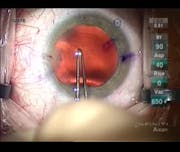PCCC After Retinal Detachment Surgery for Safe Toric IOL Implantation