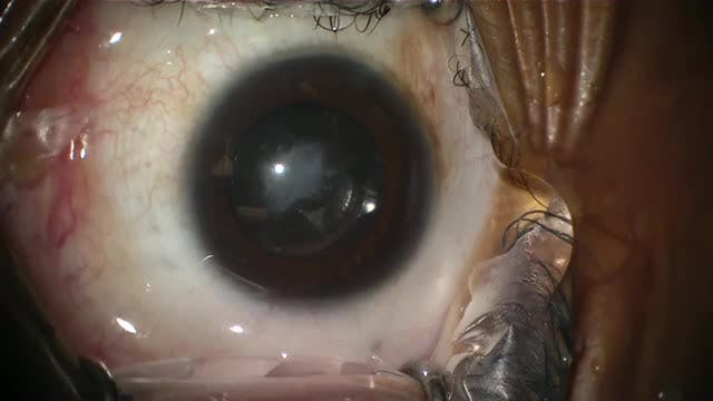 Anterior Capsule Phimosis in Myotonic Dystrophy - Eyetube