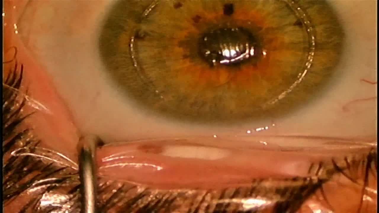 Explantation Of Raindrop® Corneal Shape-Changing Hydrogel Inlay ...