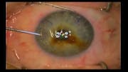 Combined LASIK and KAMRA Insertion Using the Alcon FS200