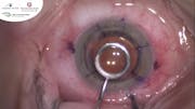 Management of High Astigmatism after Corneal Transplant: Compression Sutures and Relaxing Incisions at Donor-Host Interface