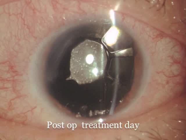 Cataract Extraction and Aniridia Capsular Ring Implantation - Eyetube