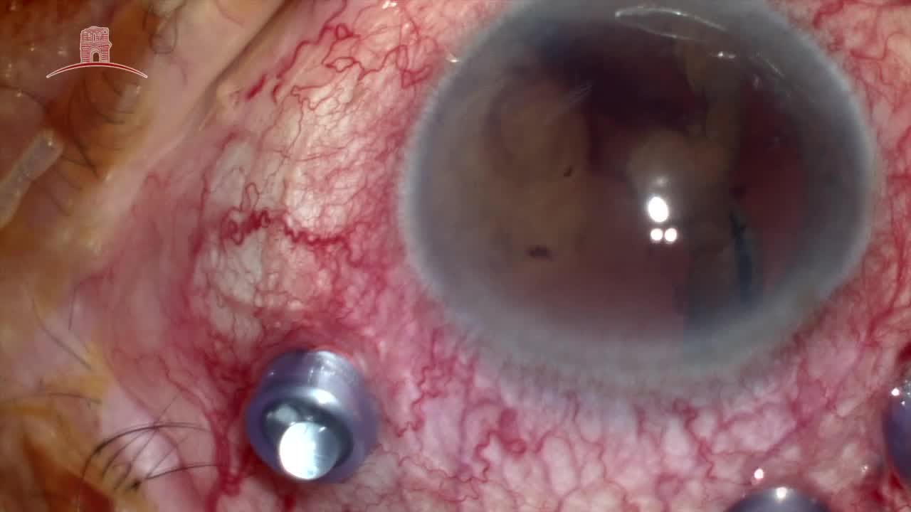 Triple Procedure - Eyetube