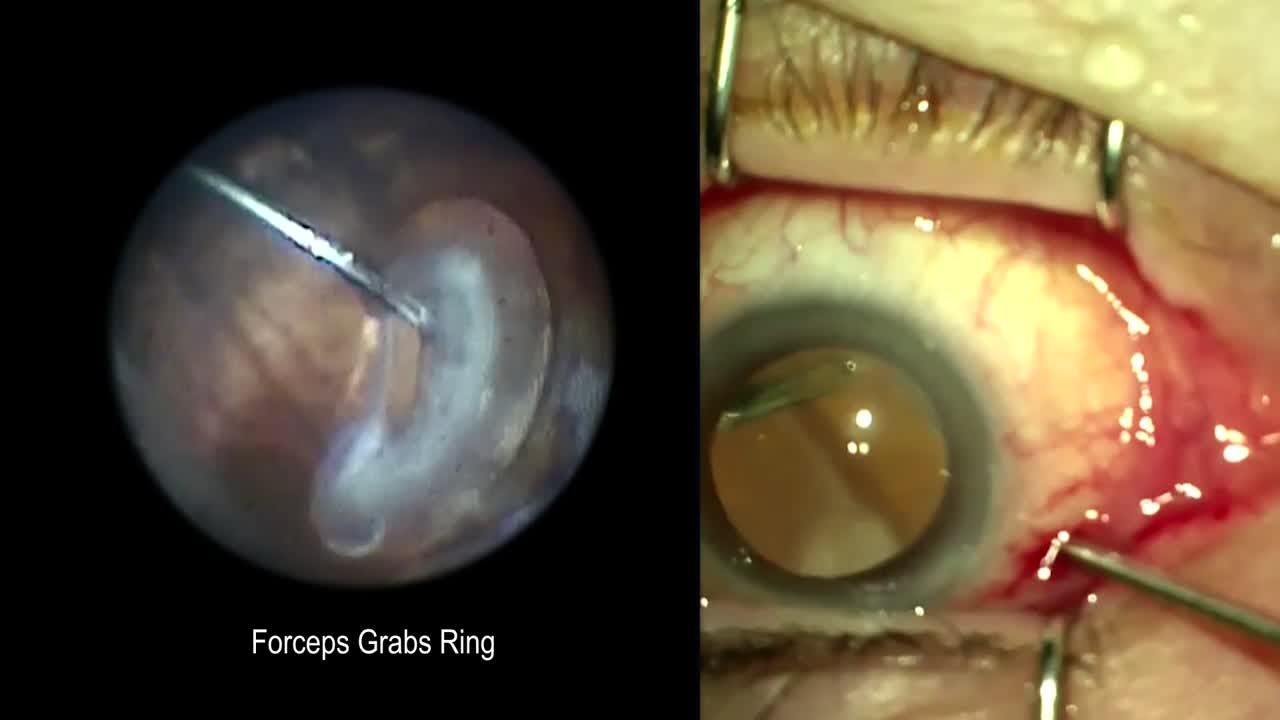 Is Giftig St Endoscopic Removal of Dislocated Soemmering Ring - Eyetube