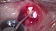 Ahmed ClearPath Small Incision