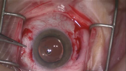 Scleral Fixation of Dislocated IOL Complex