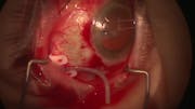 Oluwatosin Smith, MD: ClearPath Model 350 Implantation